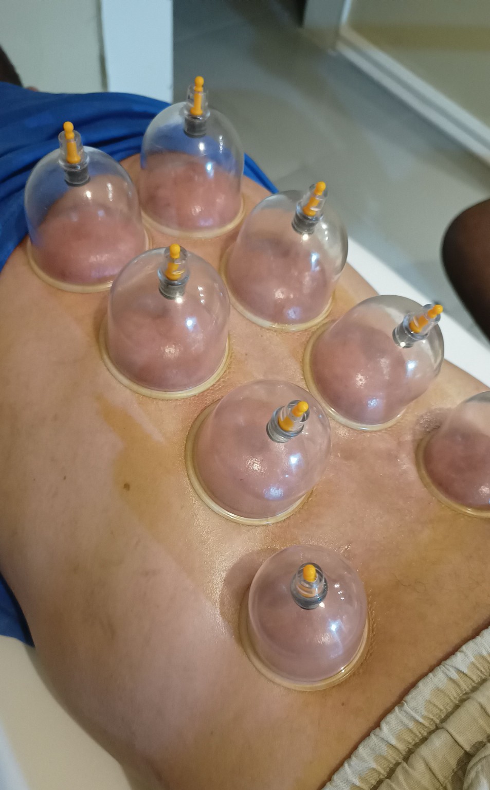 Aplicação de ventosas durante atendimento na QUIROMAX